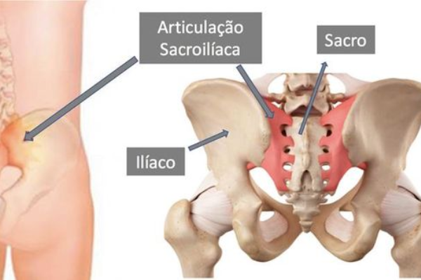 Dor nas articulações sacroilíacas
